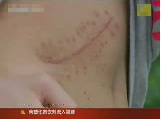 17岁高中生为买ipad2 2万元卖掉自己右肾(图)